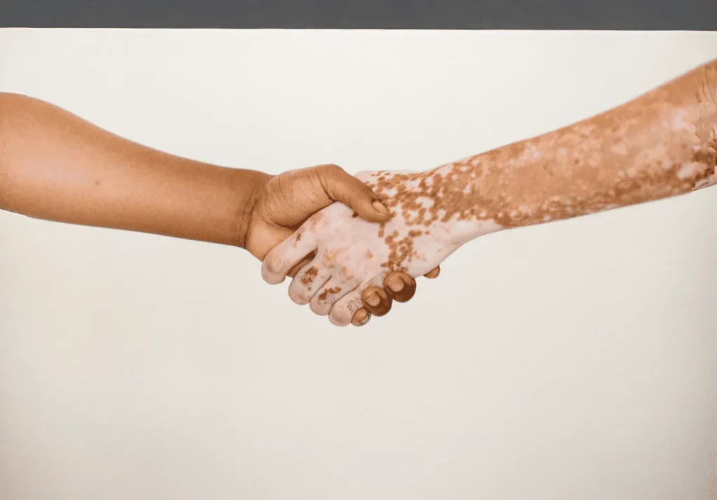 VITILIGO IS A SKIN CONDITION. NOT YOUR IDENTITY